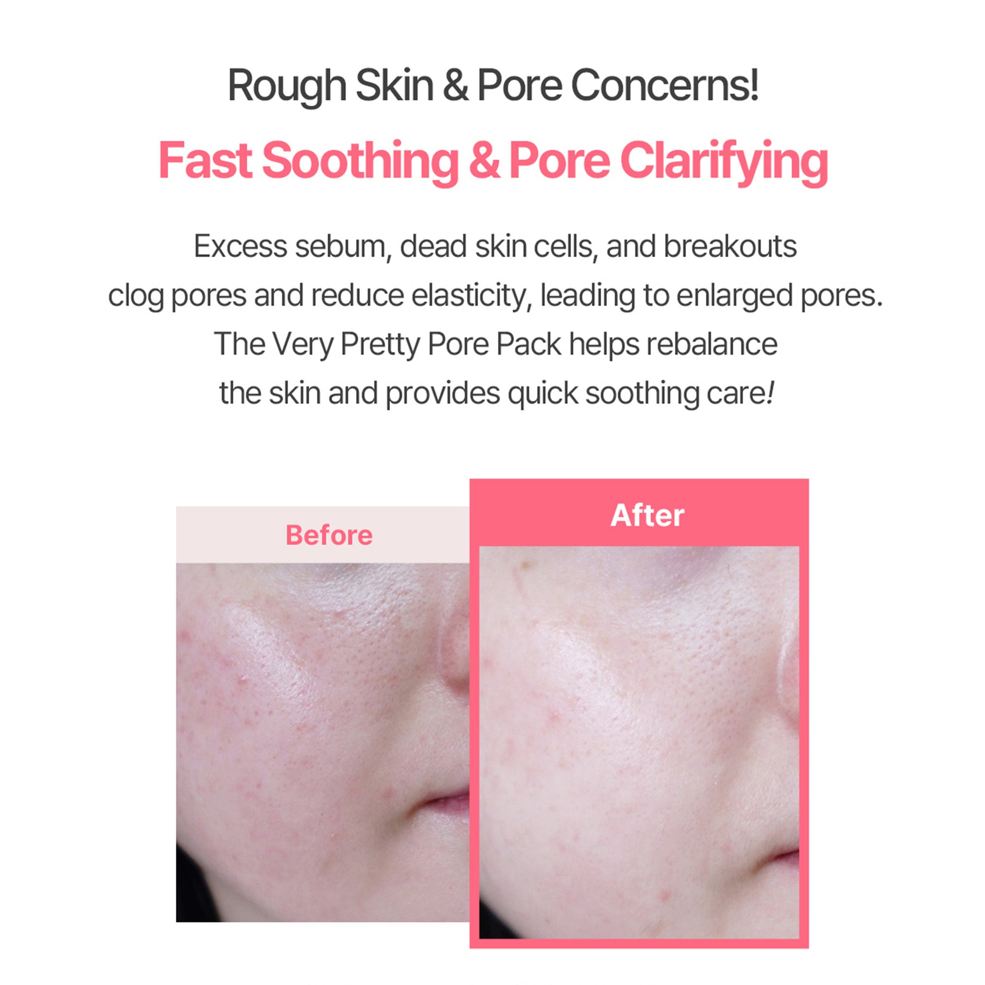 Aperire Very Pretty Pore Mask – Pore Tightening Pink Clay Mask with Calamine & Centella for Blackheads